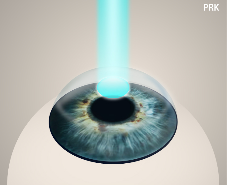 Laser PRK